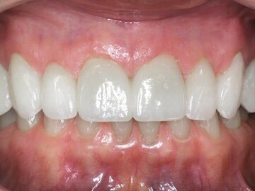 Healthy Gums