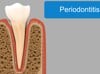 Periodontitis