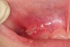 Canker Sores