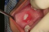 Traumatic Ulcer