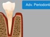 Advanced Periodontitis